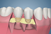 Coronal Pedicle for Root Coverage